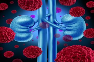 cancer-urologico