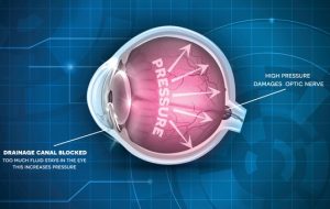 Glaucoma